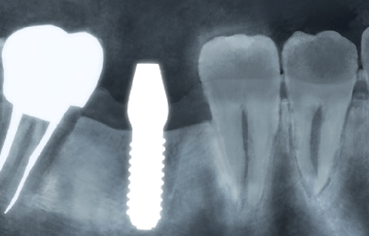 インプラントとはチタン製の人工歯根のことです