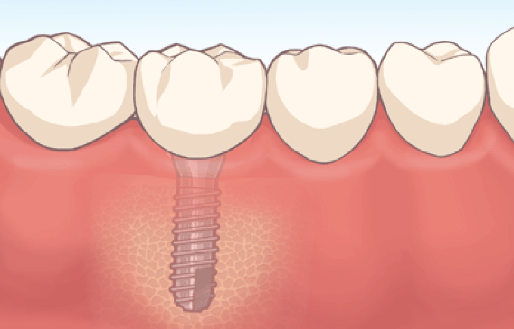 インプラントとはチタン製の人工歯根のことです